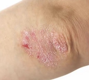 psoriaza