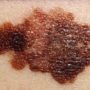 Rakovina kůže – příznaky, léčba, foto