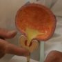 Rakovina prostaty – příznaky a léčba