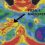 Rakovina prsu – příznaky a léčba